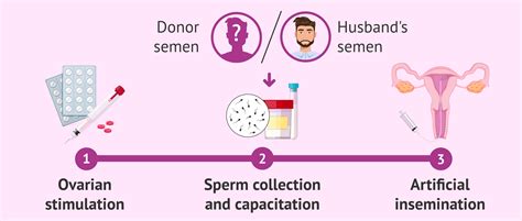 Process Of Ai With Conjugal Or Donor Sperm
