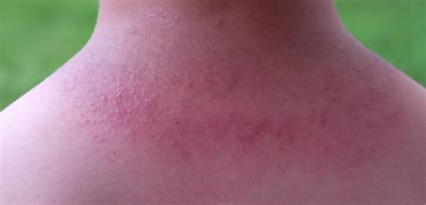 Heat Rash Pictures Treatment Symptoms Causes Riset