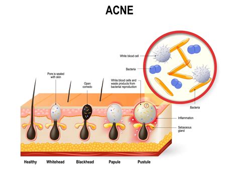 Acne Diagram