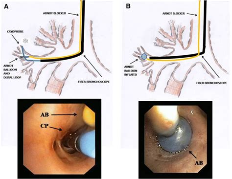 Management Of A Transbronchial Cryobiopsy Using The I Gel Airway And The Arndt Endobronchial