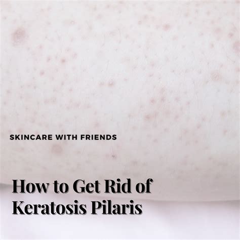 How To Get Rid Of Keratosis Pilaris Skincare With Friends