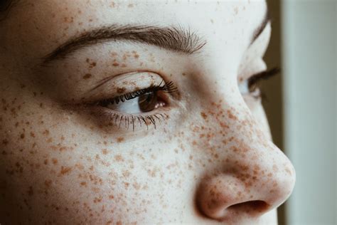 Explore The Link Between Freckles And Skin Cancer Risk Justinboey