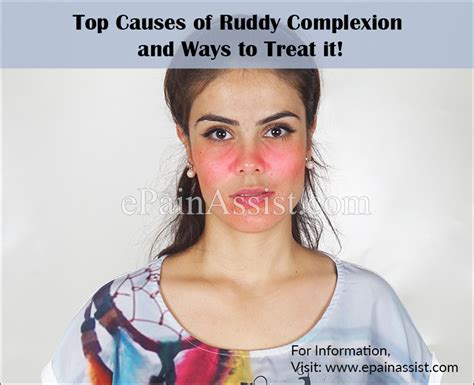 Top Causes Of Ruddy Complexion And Ways To Treat It