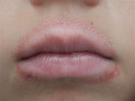 Dry Scaly Patch On Lips