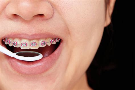 Different Types Of Orthodontic Treatments Calismile Orthodontics