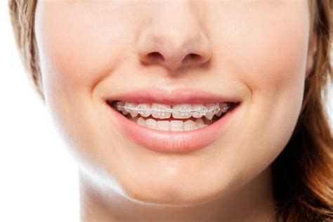 How Long Do Cosmetic Braces Take To Straighten Teeth Henry