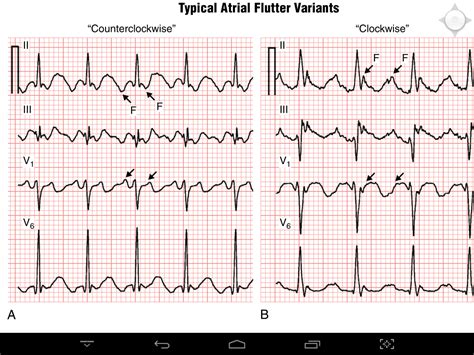 Difference Between Typical And Atypical Atrial Flutter Salomodels