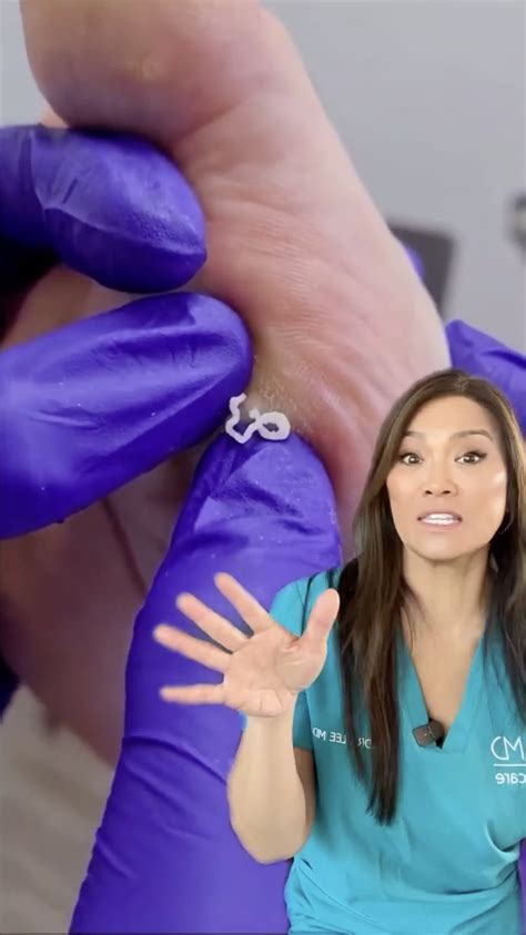 Dr Pimple Popper — Parmesan Cheese Noodles Scraped Off Feet