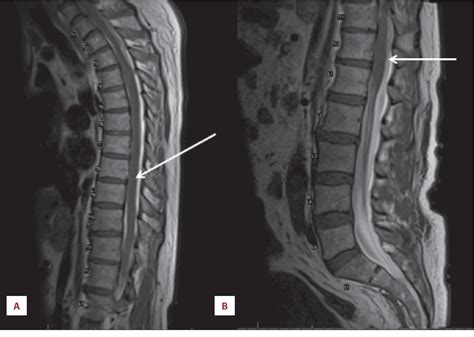 Non Traumatic Spontaneous Spinal Subdural Hematoma In A Patient With