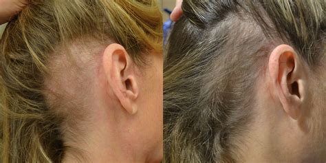 Female Hair Loss Case Study Prp Injection Therapy Hair Restoration
