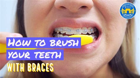 Braces Tips And Advices Archives Dental Clinic