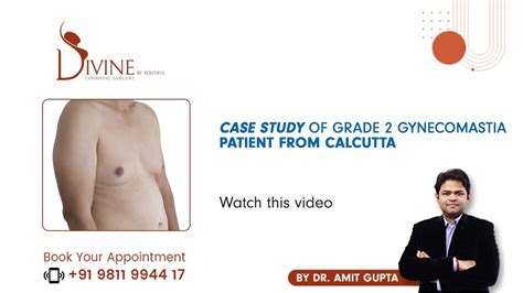 Case Study Of Grade 2 Gynecomastia Patient From Calcutta Youtube