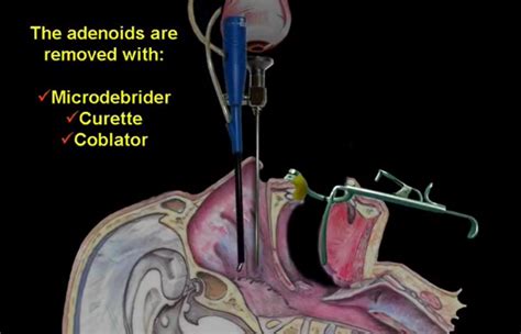Adenoidectomy Procedure