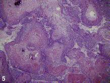 Enlarging scalp nodule in an elderly woman - Journal of ...