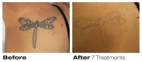 Precision Laser Tattoo Removal - Toronto, ON - 76 Richmond ... If you need a tattoo removed without any pain dr.
