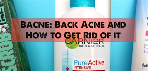 Bacne Back Acne And How To Get Rid Of It