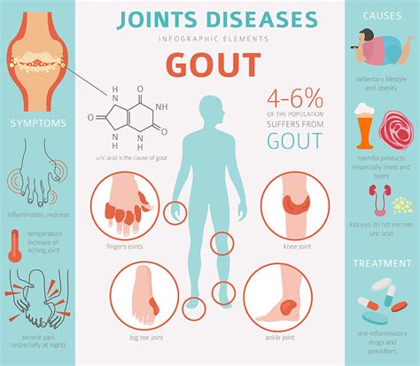 How To Remove Gout And Joint Pain Uric Acid And Crystals