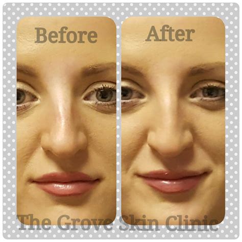 Testimonial Non Surgical Nose Reshaping The Grove Skin And Laser