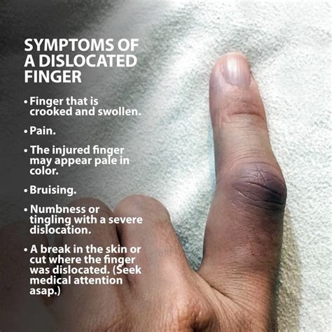 Dislocated Finger Florida Orthopaedic Institute