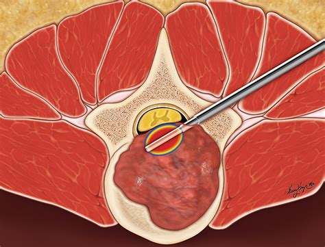 Kelly Kage Medical Illustration