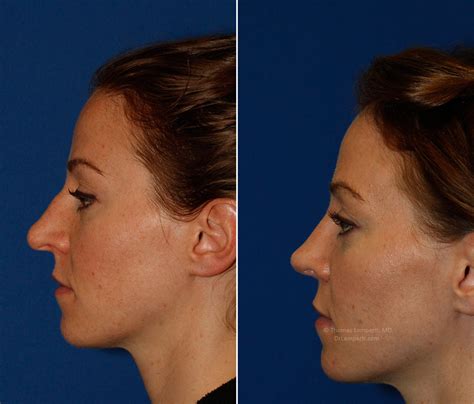 Hump Removal Rhinoplasty In Seattle Rhinoplasty Surgeon