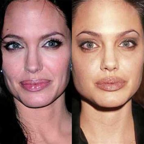 Angelina Jolie Before And After Plastic Surgery Celebrity Plastic Surgery Online