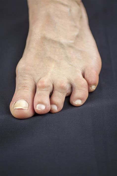 Foot Of Woman Deformed From Rheumatoid Arthritis Stock Image Image Of