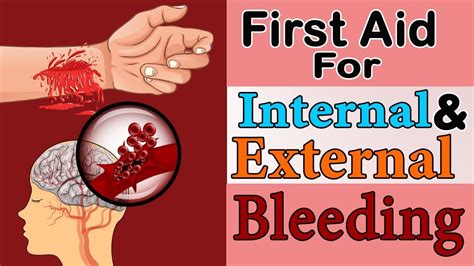 First Aid For External And Internal Bleeding Great Wall Corporate