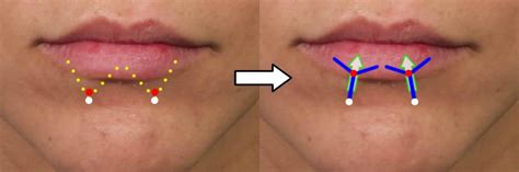 How To Reduce Lips Without Surgery