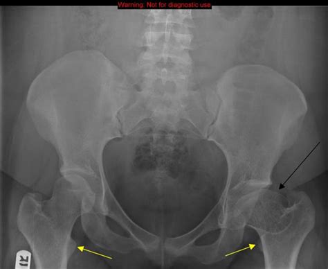 Paediatric Hip Disorders Perthes Ddh Scfe Geeky Medics