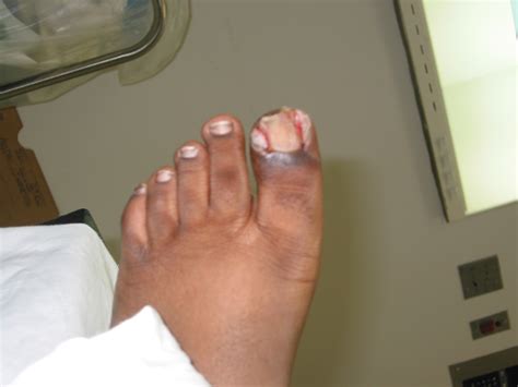 Mrsa Foot Infection Foot Doctor San Diego La Jolla Podiatrist