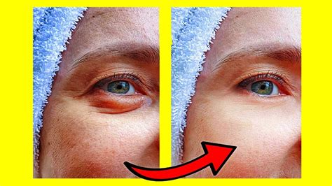 4 remedios caseros para eliminar ojeras y bolsas bajo los ojos youtube