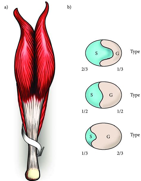 It serves to attach the plantaris, gastrocnemius (calf) and soleus muscles to the calcaneus (heel) bone. a) Posterior view of the right leg. Arrow illustrating the ...