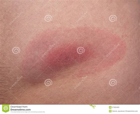 Lyme Borreliosis From A Tick Bite Stock Photo Image Of Area Tick