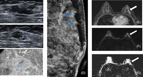 Value Of Multimodal Imaging In The Diagnosis Of Breast Sclerosing
