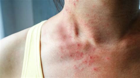 10 Things Itchy Skin Says About Your Health In 2020 Dermatitis