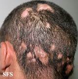 Scalp Ringworm Medication Pictures
