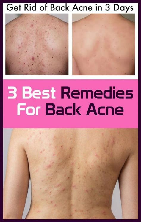 3 Best Remedies For Back Acne Back Acne Remedies Best Acne Remedies