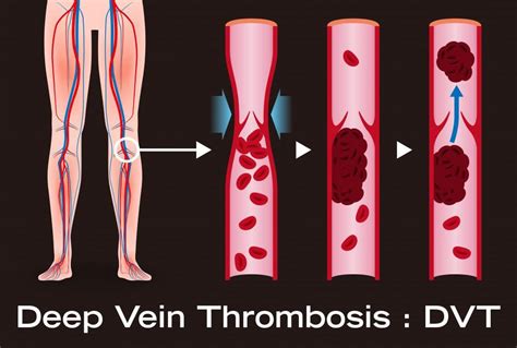 Why Do My Legs Swell By The End Of The Day Center For Varicose Veins