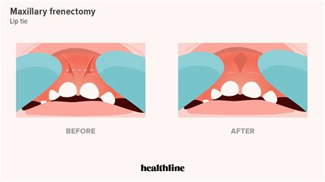 Laser Frenectomy Lower Lip Recovery