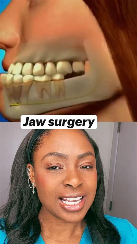 Jaw Surgery Jaw Surgery Healthy Teeth Braces Tips
