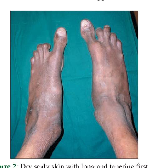 Figure From Marfan Syndrome Report Of Two Cases With Review Of