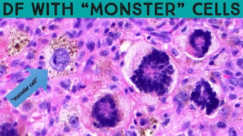 Dermatofibroma With Monster Cells Scary Name Benign Tumor Dermpath