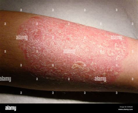 Psoriasis On An Arm Stock Photo Alamy