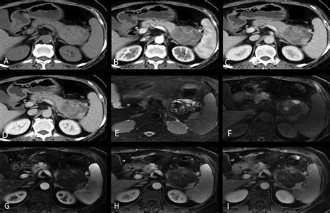 Abdominal Computed Tomography Ct Shows The Presence Of A