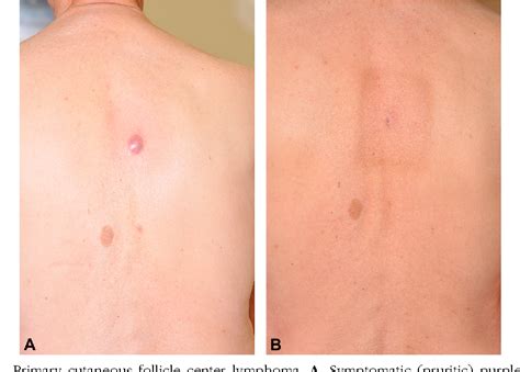 Figure 4 From Primary Cutaneous B Cell Lymphomas Part Ii Therapy And