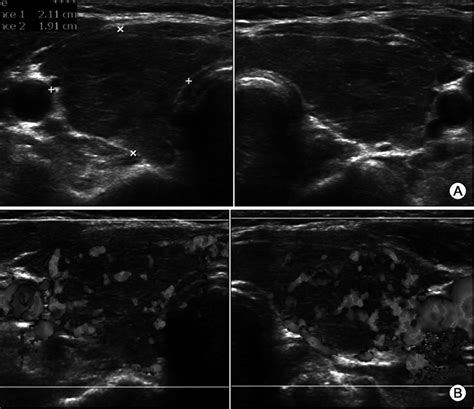 Thyroid Ultrasound In Transverse View Showed A Heterogeneous Parenchyma