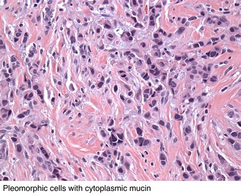 Pathology Outlines Invasive Lobular Carcinoma