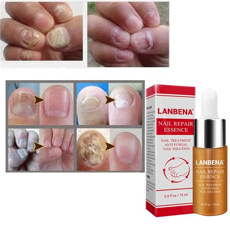 Good Result Toe Nail Fungus Treatment Cream Onychomycosis Paronychia