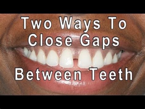 How to close gaps in teeth without braces. Ribbond Single Visit Bridge Technique | Doovi